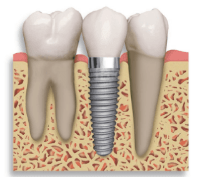 Figura 4 – Immagine schematica di un impianto con una protesi in mezzo a due denti naturali.