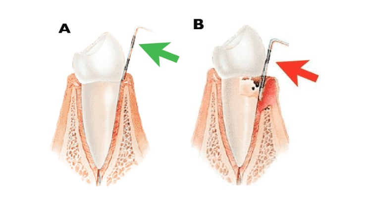 Figura 2 – Confronto tra un dente sano con tessuto parodontale intatto (A) e dente ammalato di malattia parodontale con tessuto parodontale parzialmente perduto (B). Notare come nel dente sano lo strumento calibrato (la “sonda parodontale”, indicata dalla freccia verde) penetra poco tra dente e gengiva, mentre nel dente ammalato la sonda penetra più profondamente