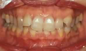 Immagine clinica: Trattamento dei disturbi dell’articolazione temporo mandibolare – immagine 2