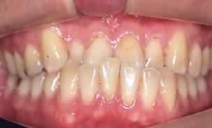 Immagine clinica: Trattamento dei disturbi dell’articolazione temporo mandibolare – immagine 1