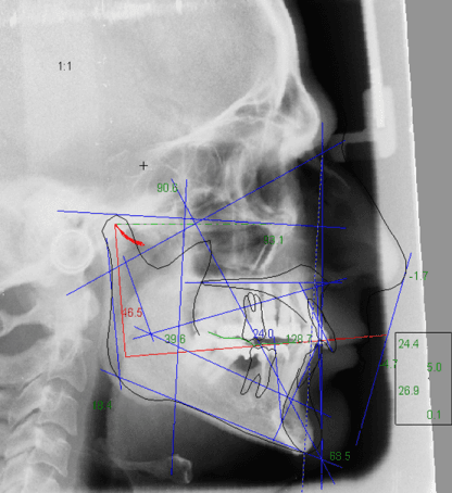 Immagine clinica: Trattamento dei disturbi dell’articolazione temporo mandibolare